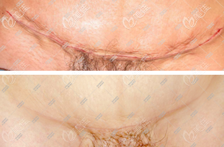 腹壁成形術(shù)疤痕照片