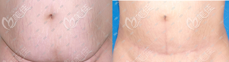 腹壁成形術(shù)疤痕照片