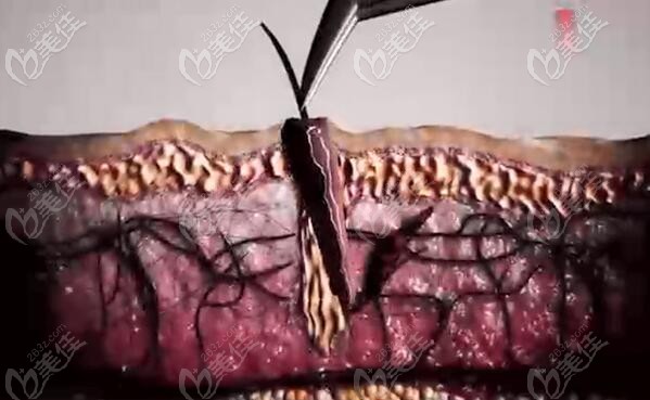 將培育好的毛囊種植到孔內(nèi)