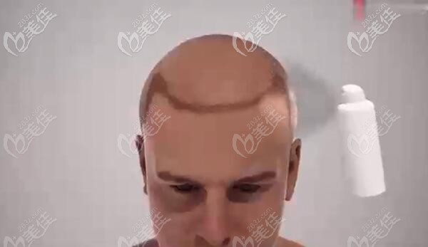 植發(fā)后做好術(shù)后護理工作