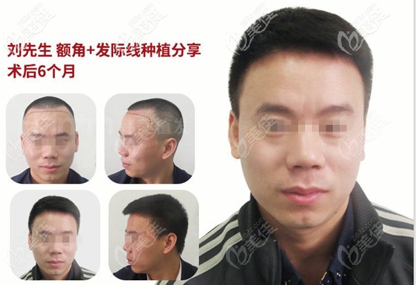 韓美利用AHT+PTT技術(shù)植發(fā)際線