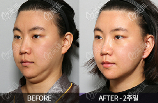 韓國Liting整形外科面部提升去雙下巴<span style=