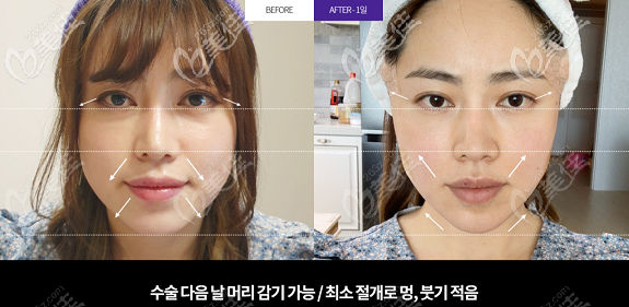 韓國Liting整形外科面部小拉皮手術(shù)<span style=