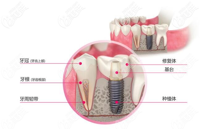 韓國dio種植體新出的UF型號