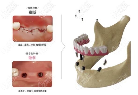 dio數(shù)字化種植系統(tǒng)