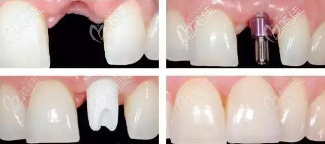 前門牙種植修復(fù)