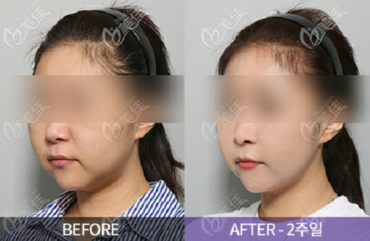 權(quán)泳勛迷你切開面部提升<span style=