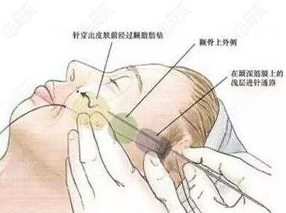 沈陽騰采醫(yī)療美容做面部埋線提升技術優(yōu)勢