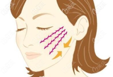 沈陽做面部埋線提升哪家醫(yī)院好