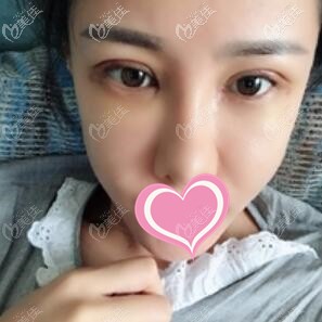 割雙眼皮術(shù)后3天照 割雙眼皮術(shù)后3天照