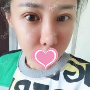 割完雙眼皮術(shù)后一周拆線照 割完雙眼皮術(shù)后一周拆線照