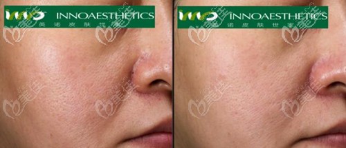 使用2次英諾小棕瓶后毛孔對比