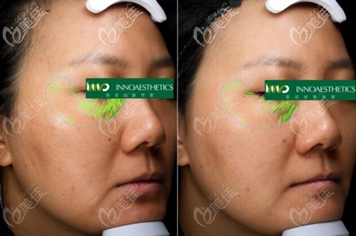 使用4次英諾抗曬素后眼周細紋對比