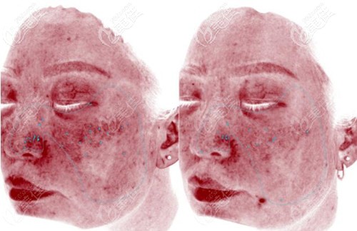 使用4次英諾抗曬素后鼻翼泛紅對比