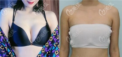 黃名斗做的傲諾拉隆胸60天療效對(duì)比圖