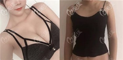 黃名斗做的曼托250cc假體隆胸術(shù)后半年療效