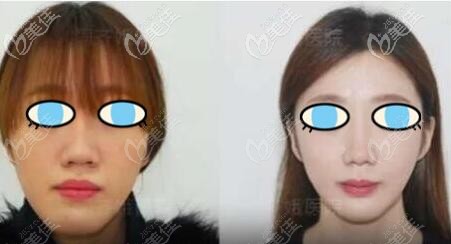 長臉正頜手術(shù)變短臉真實案例效果圖片