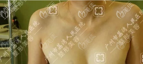 廣州荔灣區(qū)人民醫(yī)院整形美容中心齊云香術(shù)前照片1