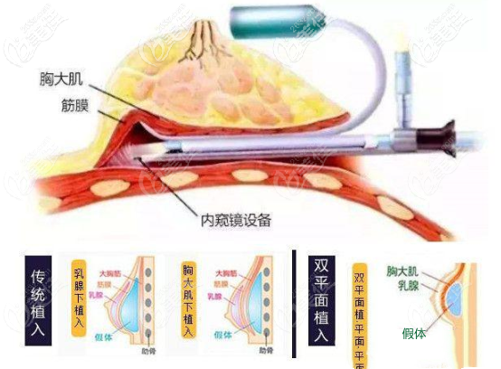 內(nèi)窺鏡顯微技術(shù)+雙平面技術(shù)