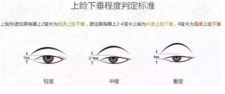 上瞼下垂程度判定標(biāo)準(zhǔn)