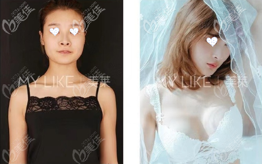 王洪醫(yī)生內(nèi)窺鏡雙平面曼托假體隆胸效果圖