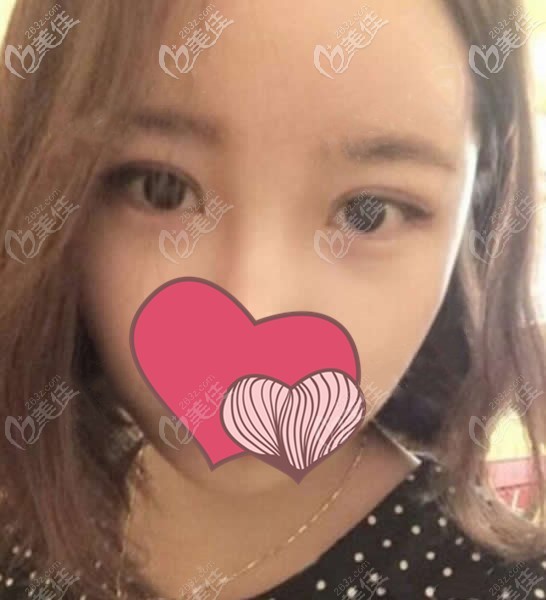 蘭州田海峰醫(yī)生給我做的全切雙眼皮4個月眼睛就不腫了，而且效果還恢復(fù)了七八成呢