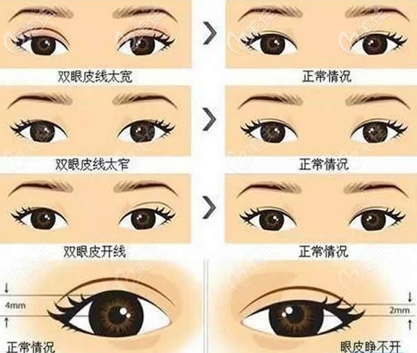 雙眼皮失敗表現(xiàn)癥狀