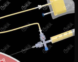 北京達(dá)美如藝脂肪膠豐胸術(shù)采用的特色定制脂肪萃取器示意圖