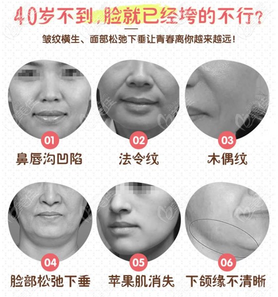 40歲后臉部松弛下垂的部位