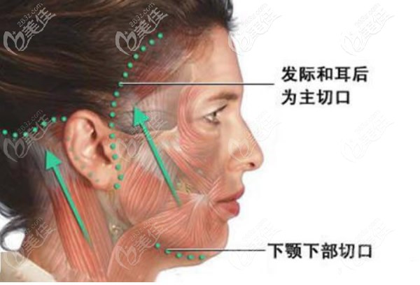 面部大拉皮手術(shù)切口位置示意圖