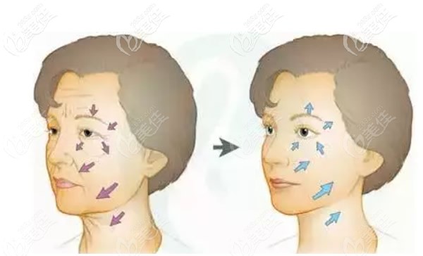 大拉皮面部除皺前后對比照片