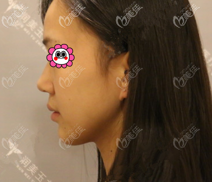 我在北京潤美玉之光做蛋白線面部提升前 我在北京潤美玉之光做蛋白線面部提升前