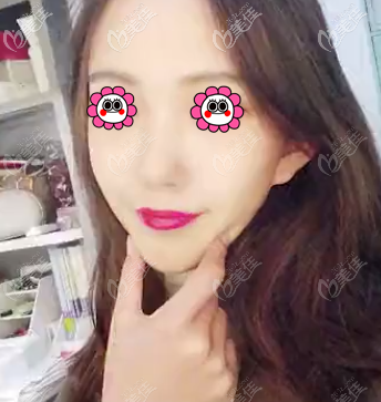 做蛋白線面部提升沒有副作用好開心 做蛋白線面部提升沒有副作用好開心