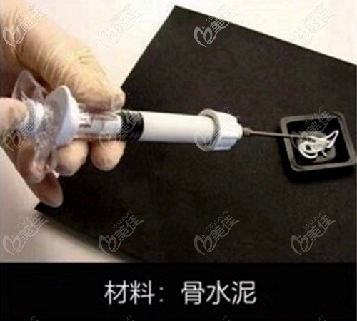 韓國愛婷填充后腦勺用的骨水泥 韓國愛婷填充后腦勺用的骨水泥