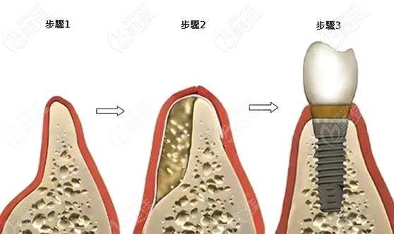 牙槽骨萎縮植骨粉再做種植過程 牙槽骨萎縮植骨粉再做種植過程