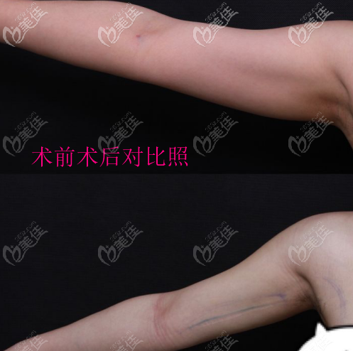 手臂吸脂后術(shù)前術(shù)后對比圖 手臂吸脂后術(shù)前術(shù)后對比圖