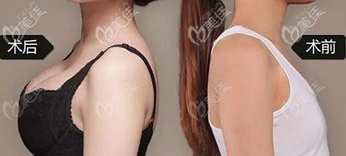 曼托魅力版隆胸案例