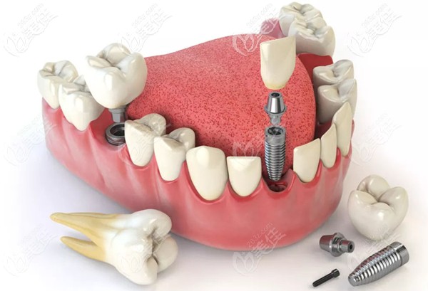 種植體基臺牙冠展示圖