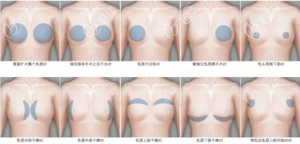 南京自體脂肪隆胸