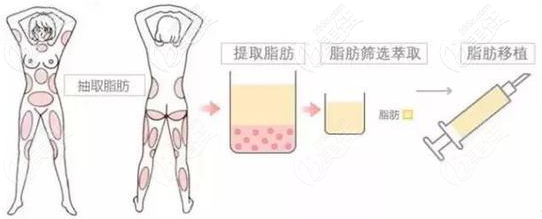 南京自體脂肪隆胸注射幾次？