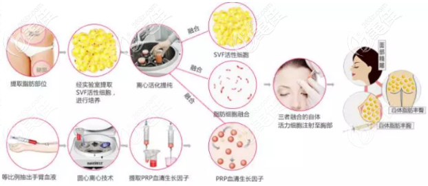 南京藝星自體脂肪隆胸技術(shù)優(yōu)勢