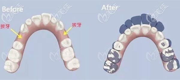 正畸拔牙前和關閉牙縫后的效果
