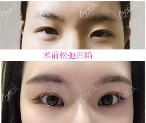 上眼皮松弛凹陷做的窄的開扇型雙眼皮案例一 上眼皮松弛凹陷做的窄的開扇型雙眼皮案例一