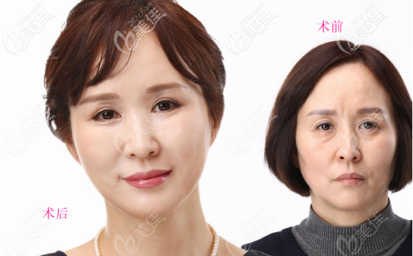 上眼皮松弛凹陷做的窄的開扇型雙眼皮案例三 上眼皮松弛凹陷做的窄的開扇型雙眼皮案例三