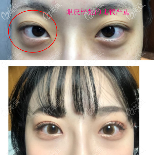 上眼皮松弛凹陷做的窄的開扇型雙眼皮案例四 上眼皮松弛凹陷做的窄的開扇型雙眼皮案例四