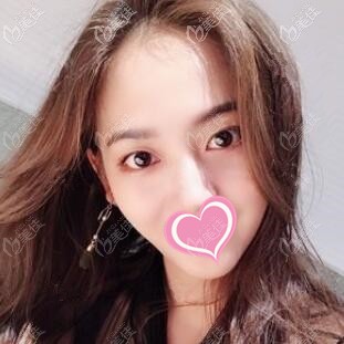 做內(nèi)切祛眼袋術(shù)后半個(gè)月效果照 做內(nèi)切祛眼袋術(shù)后半個(gè)月效果照