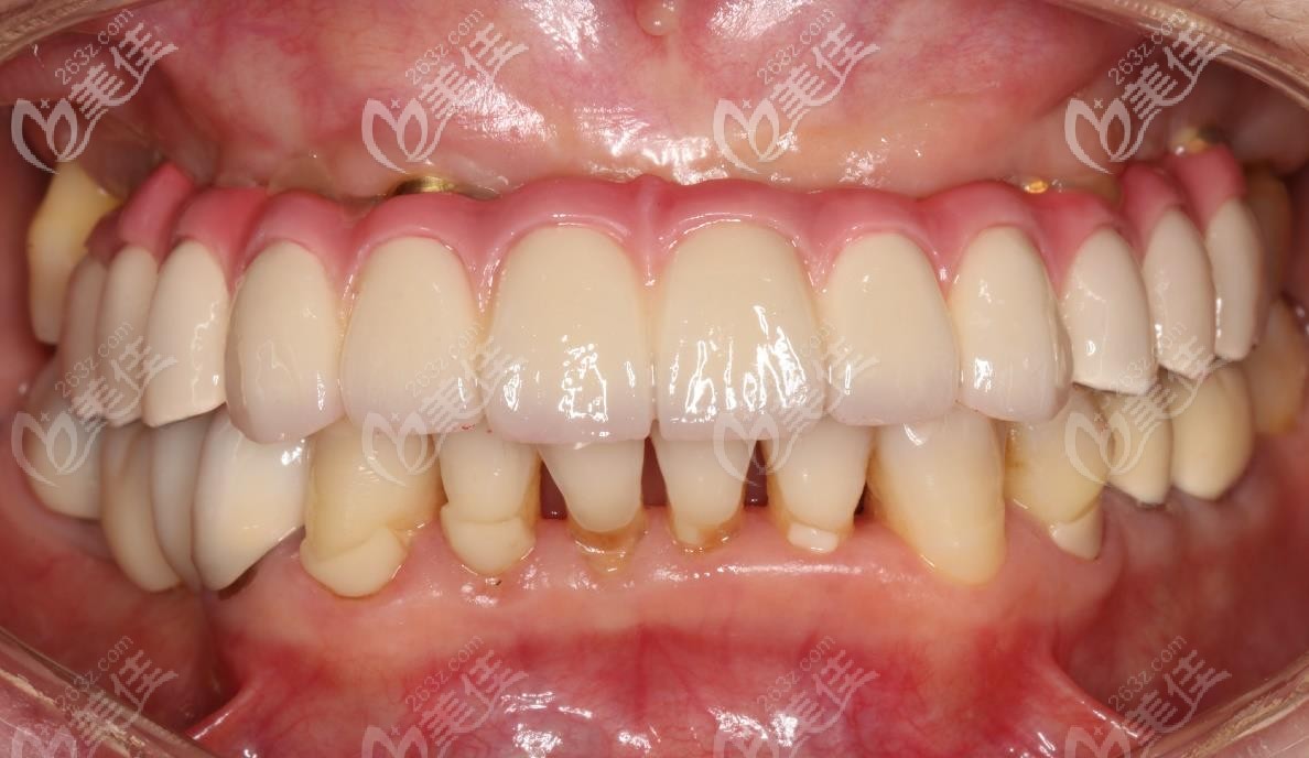 64歲阿姨上頜半口牙齒缺失,用allon6即刻負(fù)重技術(shù)修復(fù)了滿口牙