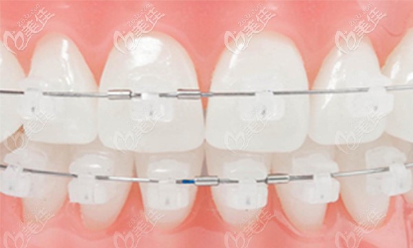 唯格口腔牙齒矯正費(fèi)用