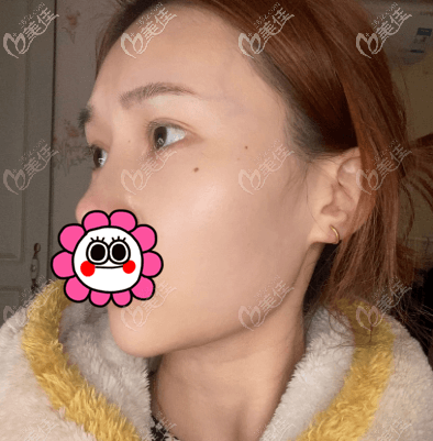 做熱瑪吉眼部除皺第8天了