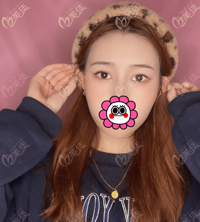 熱瑪吉五代對(duì)眼周細(xì)紋還是有效果的,做完2個(gè)月左右效果就明顯了